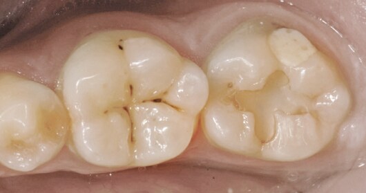 Klinik diş hekimliği ve fotoğraflar: Dr. Guiseppe Chiodera, Brescia, İtalya 
