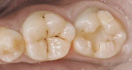 Mandibular ikinci molarda iki restorasyonun estetik replasmanının görüntüsü
