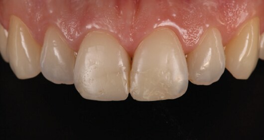 Anterior sınıf IV restorasyonların estetik restorasyonu.
